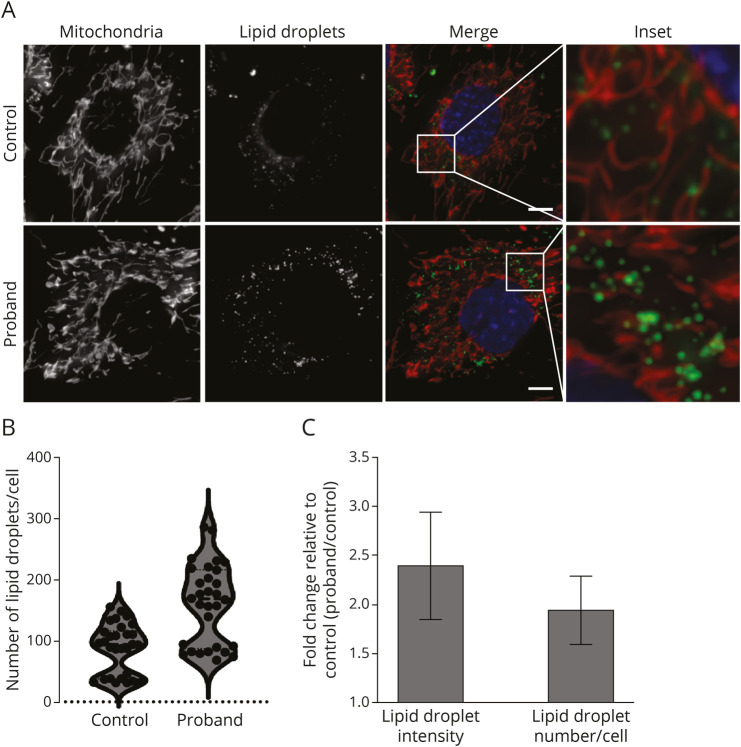 Full-length Isoform Sequencing for Resolving the Molecular Basis of Charcot-Marie-Tooth 2A.