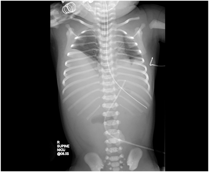 Fetoscopic endoluminal tracheal occlusion (FETO) and bilateral congenital diaphragmatic hernia.
