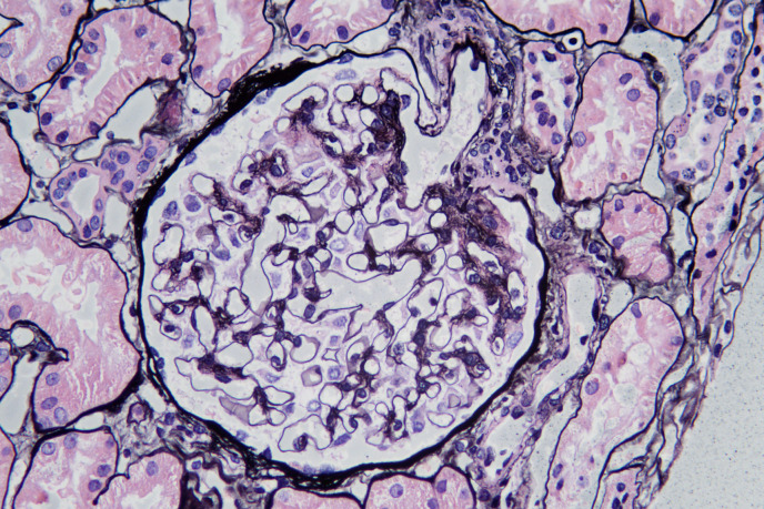Segmental Membranous Glomerulopathy in Adults.