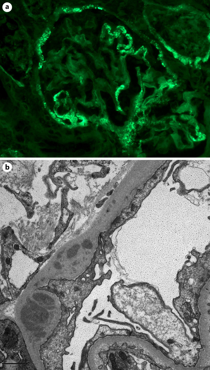 Segmental Membranous Glomerulopathy in Adults.
