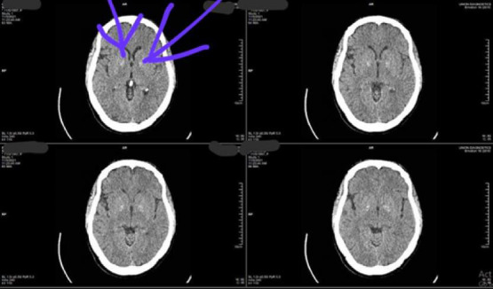 ACUTE CHOREO-DYSTONIA IN A NEWLY DIAGNOSED PATIENT WITH DIABETES MELLITUS: A CASE REPORT AND REVIEW OF LITERATURE.
