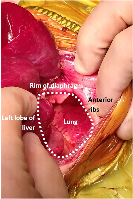 Fetoscopic endoluminal tracheal occlusion (FETO) and bilateral congenital diaphragmatic hernia.
