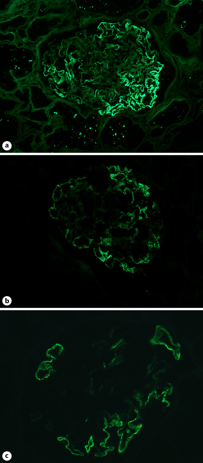 Segmental Membranous Glomerulopathy in Adults.