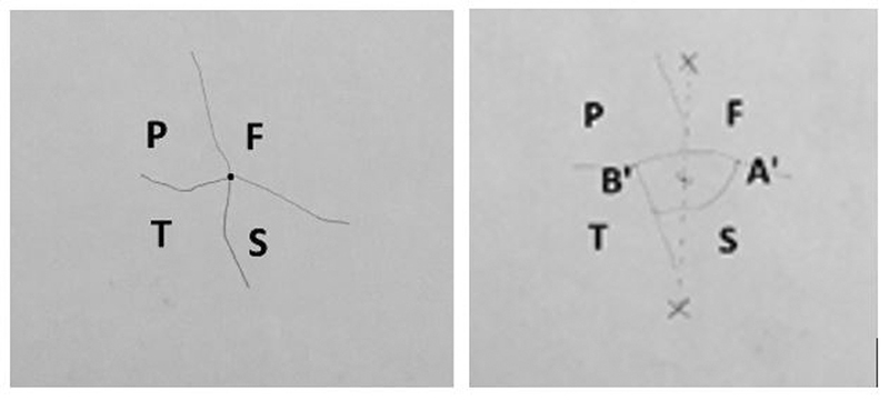 Analysis of the Variations in the Morphology, Topography of the Pterion, and Their Implications in Neurosurgery: An Osteometric Study.