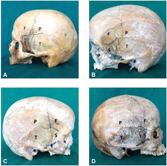 Analysis of the Variations in the Morphology, Topography of the Pterion, and Their Implications in Neurosurgery: An Osteometric Study.