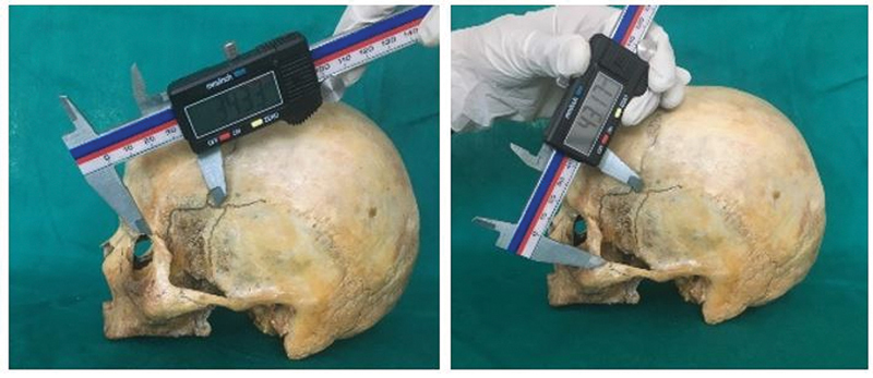 Analysis of the Variations in the Morphology, Topography of the Pterion, and Their Implications in Neurosurgery: An Osteometric Study.