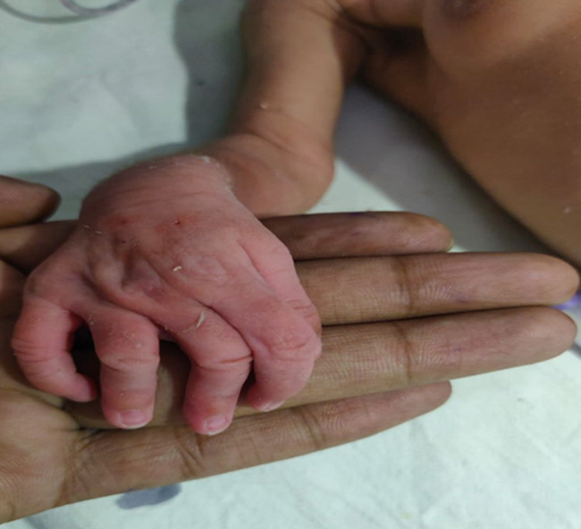 A twelve days' male baby with clinodactyly: a rare clinical image.