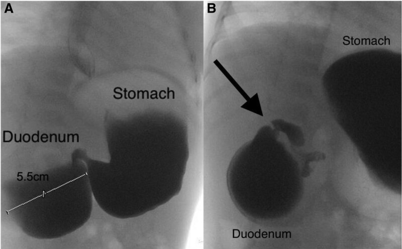 Avoiding Surgery: Endoscopic Treatment of Congenital Duodenal Stenosis.