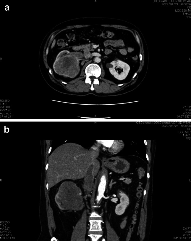 Sarcomatoid renal cell carcinoma with an inferior vena cava tumor thrombus that was completely resected by robot-assisted laparoscopic radical nephrectomy after neoadjuvant therapy nivolumab plus ipilimumab: a case report.
