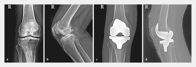 [Akute arterielle Embolie nach einer Knie-Totalendoprothese: Ein Bericht über zwei Fälle und Literaturübersicht].