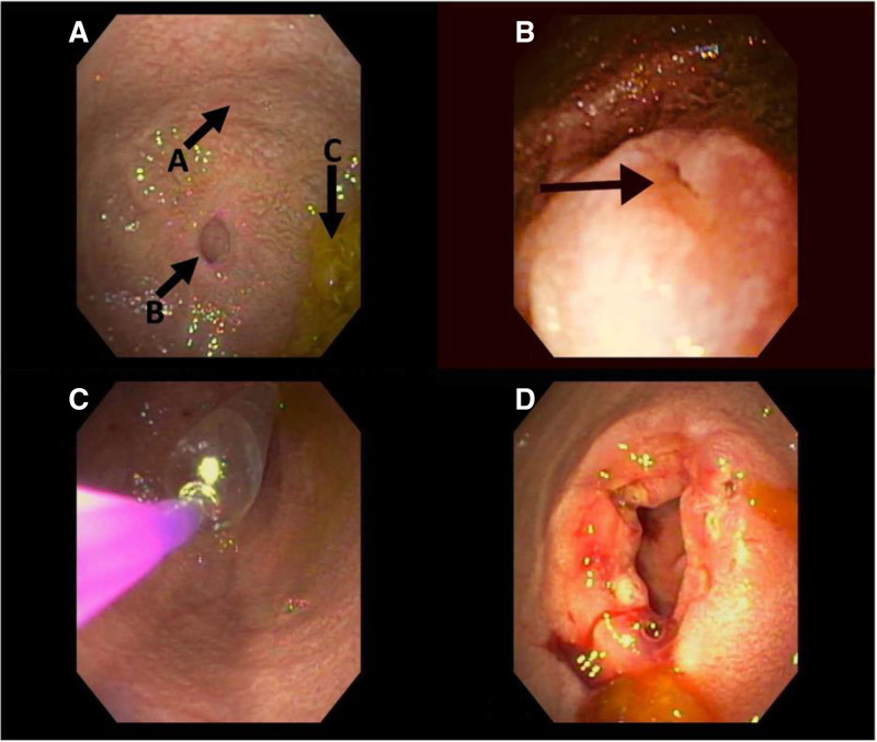 Avoiding Surgery: Endoscopic Treatment of Congenital Duodenal Stenosis.