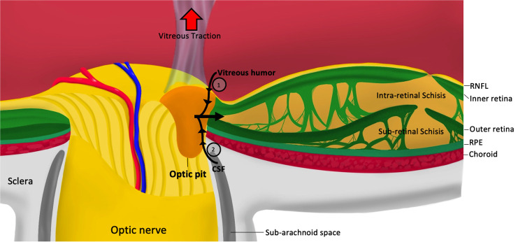 Congenital optic disc pits and optic disc pit maculopathy: a review.