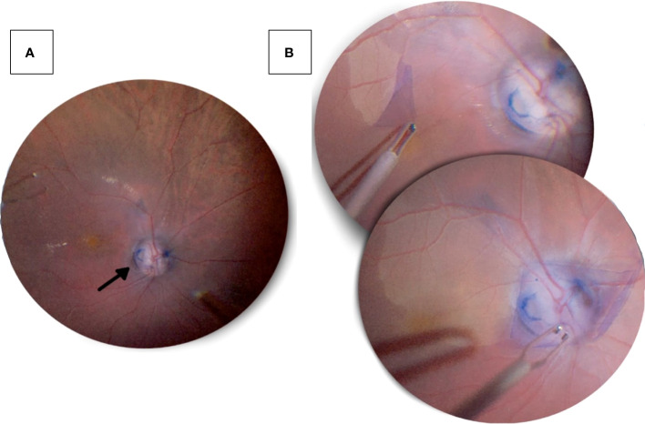 Congenital optic disc pits and optic disc pit maculopathy: a review.