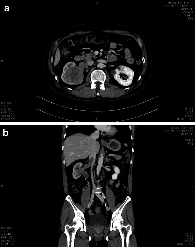 Sarcomatoid renal cell carcinoma with an inferior vena cava tumor thrombus that was completely resected by robot-assisted laparoscopic radical nephrectomy after neoadjuvant therapy nivolumab plus ipilimumab: a case report.