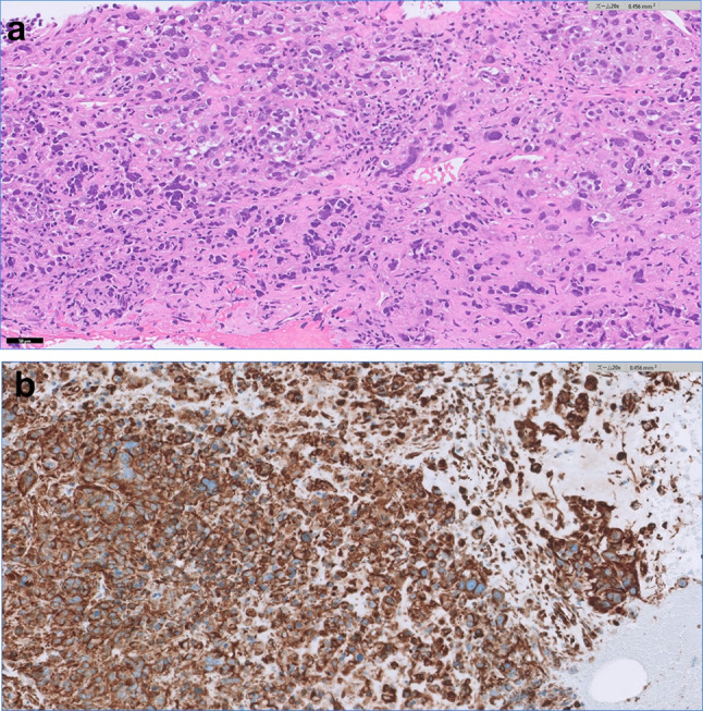 Sarcomatoid renal cell carcinoma with an inferior vena cava tumor thrombus that was completely resected by robot-assisted laparoscopic radical nephrectomy after neoadjuvant therapy nivolumab plus ipilimumab: a case report.