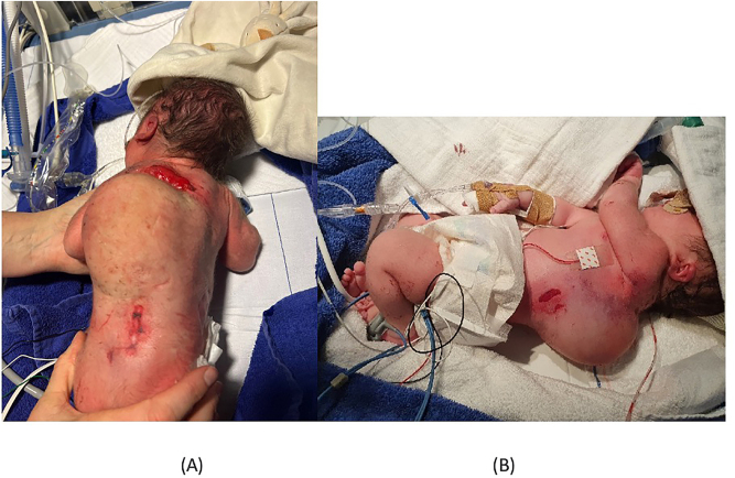 Birth-related soft tissue injury due to transverse malpresentation at delivery: a case report.