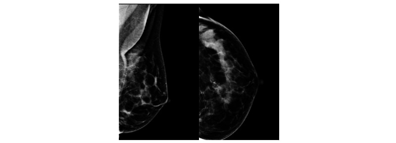 Effect of Benign Biopsy Findings on an Artificial Intelligence-Based Cancer Detector in Screening Mammography: Retrospective Case-Control Study.