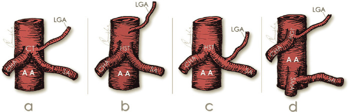 Anatomical Variations in the Celiac Trunk: A Short Review.