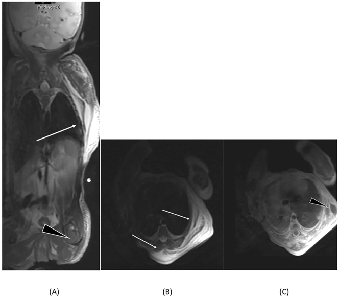 Birth-related soft tissue injury due to transverse malpresentation at delivery: a case report.
