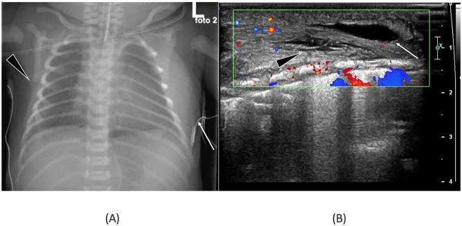 Birth-related soft tissue injury due to transverse malpresentation at delivery: a case report.