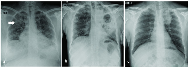 COVID-19 and <i>Mycobacterium</i> coinfection in Brunei Darussalam: case series.