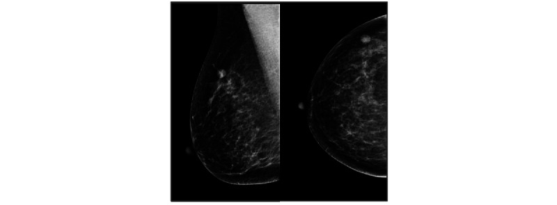 Effect of Benign Biopsy Findings on an Artificial Intelligence-Based Cancer Detector in Screening Mammography: Retrospective Case-Control Study.