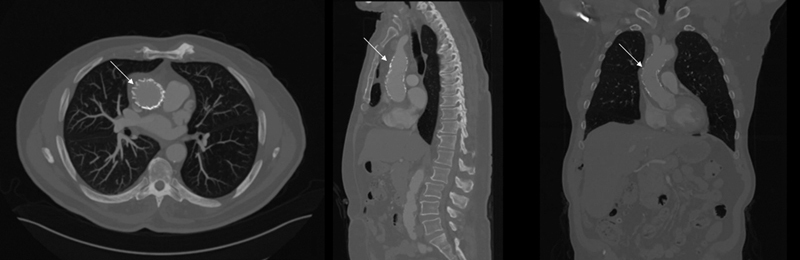 Endovascular Repair of Zone 0 Ascending Aortic Pseudoaneurysm: A Case Report.