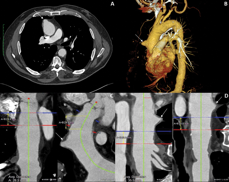 Endovascular Repair of Zone 0 Ascending Aortic Pseudoaneurysm: A Case Report.