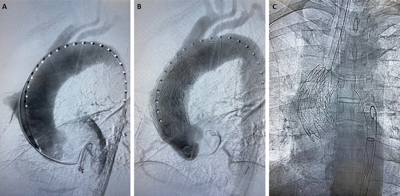 Endovascular Repair of Zone 0 Ascending Aortic Pseudoaneurysm: A Case Report.