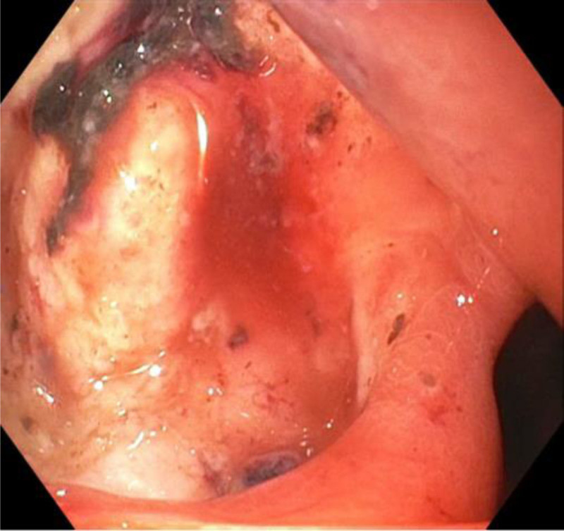 <i>Helicobacter pylori</i> Found Guilty of Obstructive Jaundice: A Pediatric Case Report.