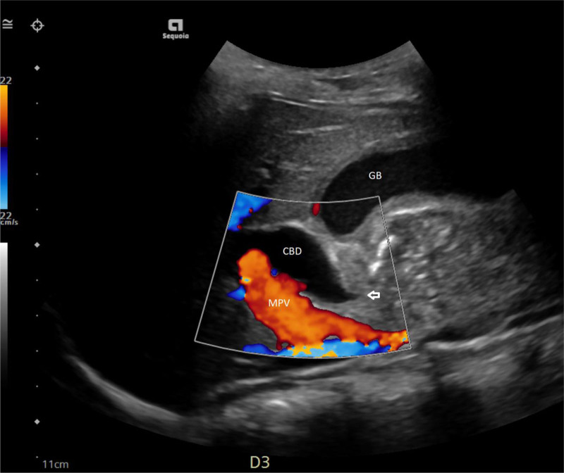 <i>Helicobacter pylori</i> Found Guilty of Obstructive Jaundice: A Pediatric Case Report.