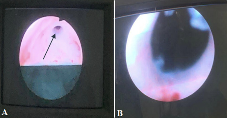 Giant stone in a urinary bladder diverticulum in a 69-year-old male: a case report.