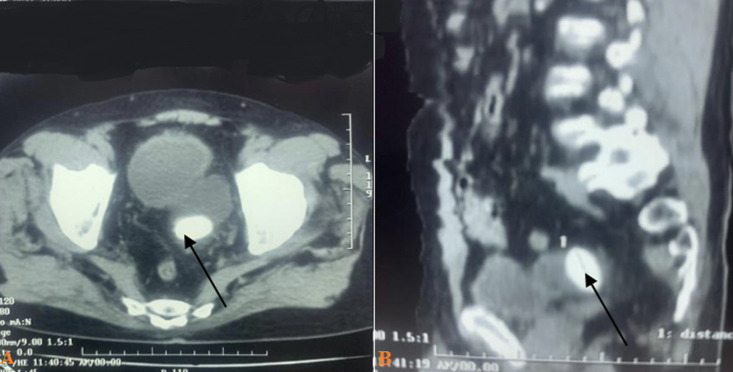 Giant stone in a urinary bladder diverticulum in a 69-year-old male: a case report.