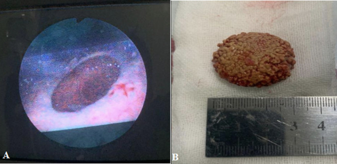 Giant stone in a urinary bladder diverticulum in a 69-year-old male: a case report.