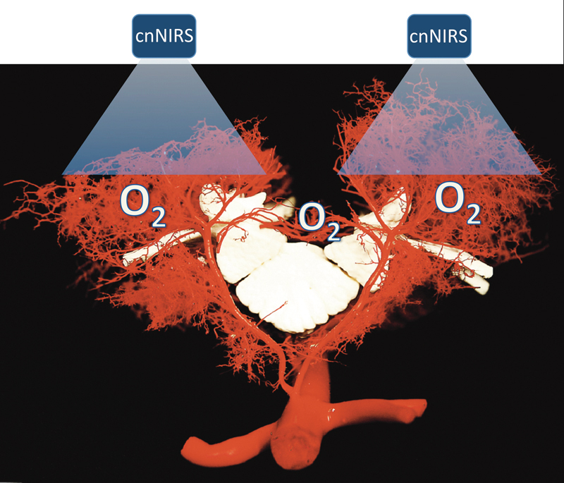 Near-Infrared Spectroscopy for Spinal Cord Monitoring-A Roadmap to Translational Research in Aortic Medicine.