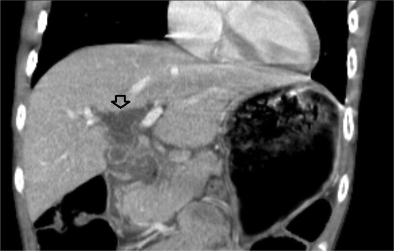 <i>Helicobacter pylori</i> Found Guilty of Obstructive Jaundice: A Pediatric Case Report.