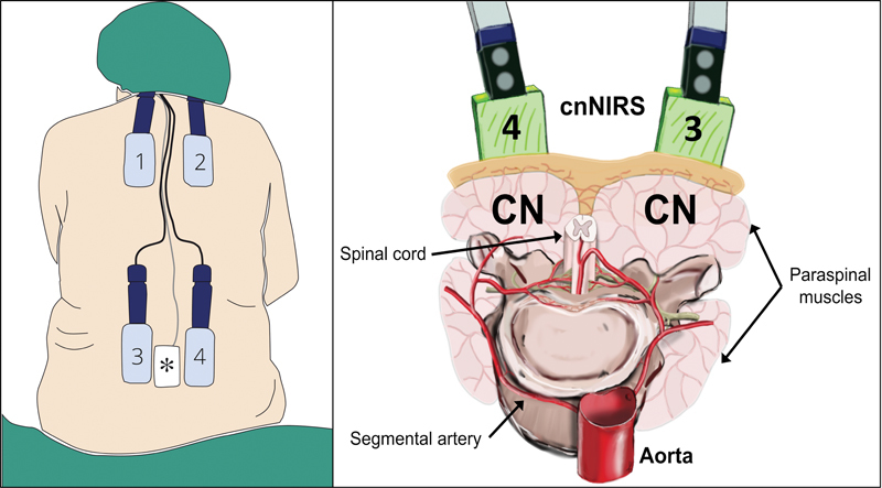 Near-Infrared Spectroscopy for Spinal Cord Monitoring-A Roadmap to Translational Research in Aortic Medicine.