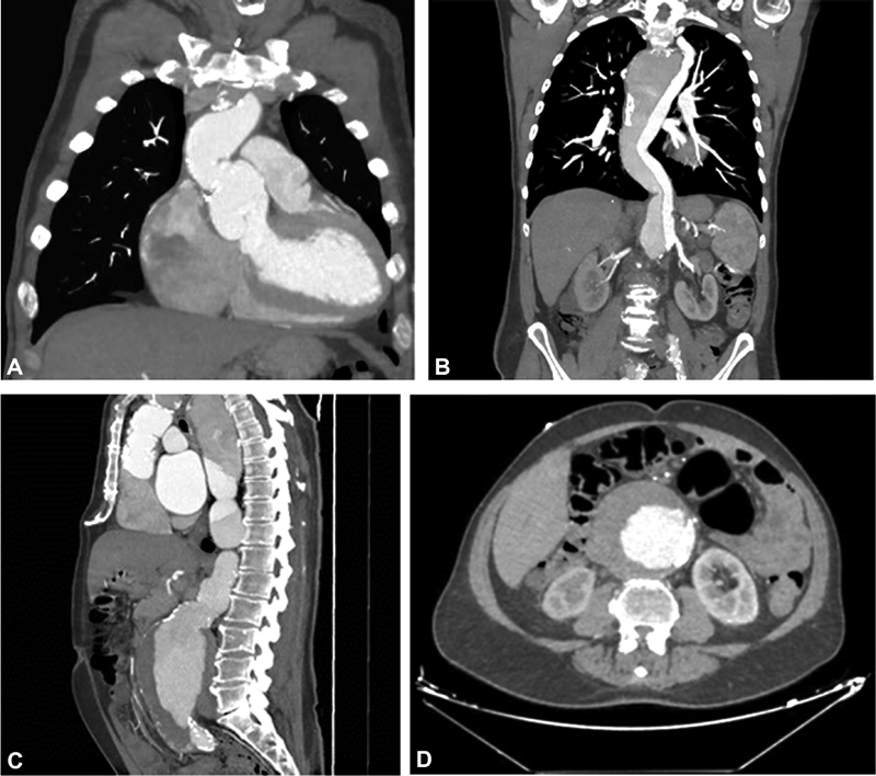 "Natural" History of Operated Type A Aortic Dissection.