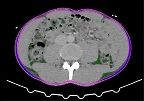 Impact of visceral fat on coronary artery disease as defined by quantitative computed tomography angiography