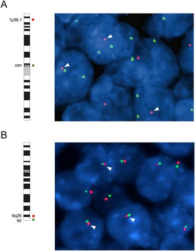 Comprehensive molecular characterization of adenoid cystic carcinoma reveals tumor suppressors as novel drivers and prognostic biomarkers