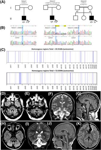 Pure cerebellar ataxia due to bi-allelic PRDX3 variants including recurring p.Asp202Asn