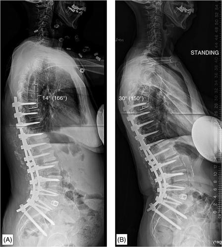 The influence of ligament biomechanics on proximal junctional kyphosis and failure in patients with adult spinal deformity