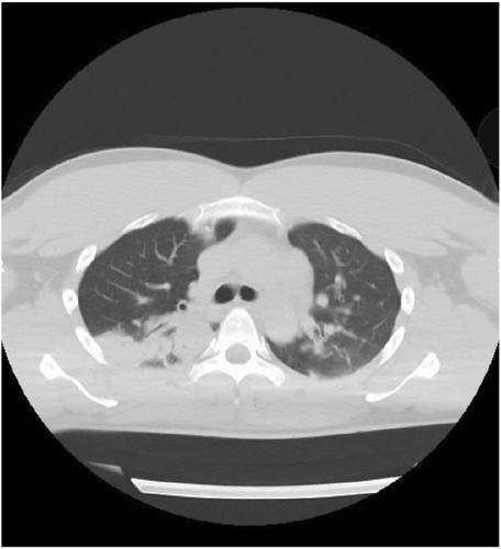 A case of mild encephalitis associated with COVID-19