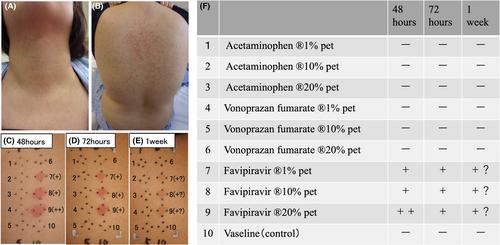 A case of disseminated erythematous drug eruption caused by favipiravir in a patient with COVID-19