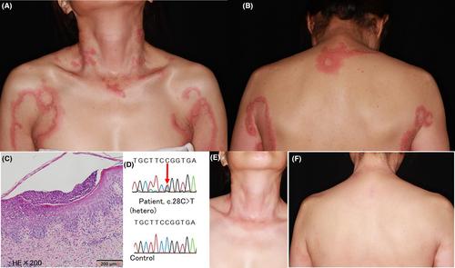 The utility of IL36RN mutation analysis in an elderly patient with generalized pustular psoriasis patient treated with secukinumab