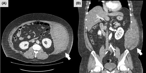 Abdominal internal oblique muscle hematoma of an obese middle-aged man induced by cough