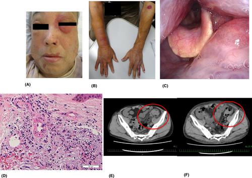 Normocomplementemic urticarial vasculitis with laryngeal and intestinal tract edema