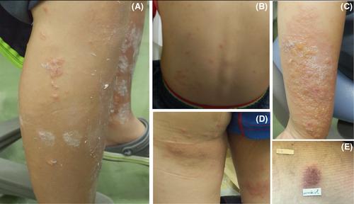 Contact dermatitis syndrome to poison ivy