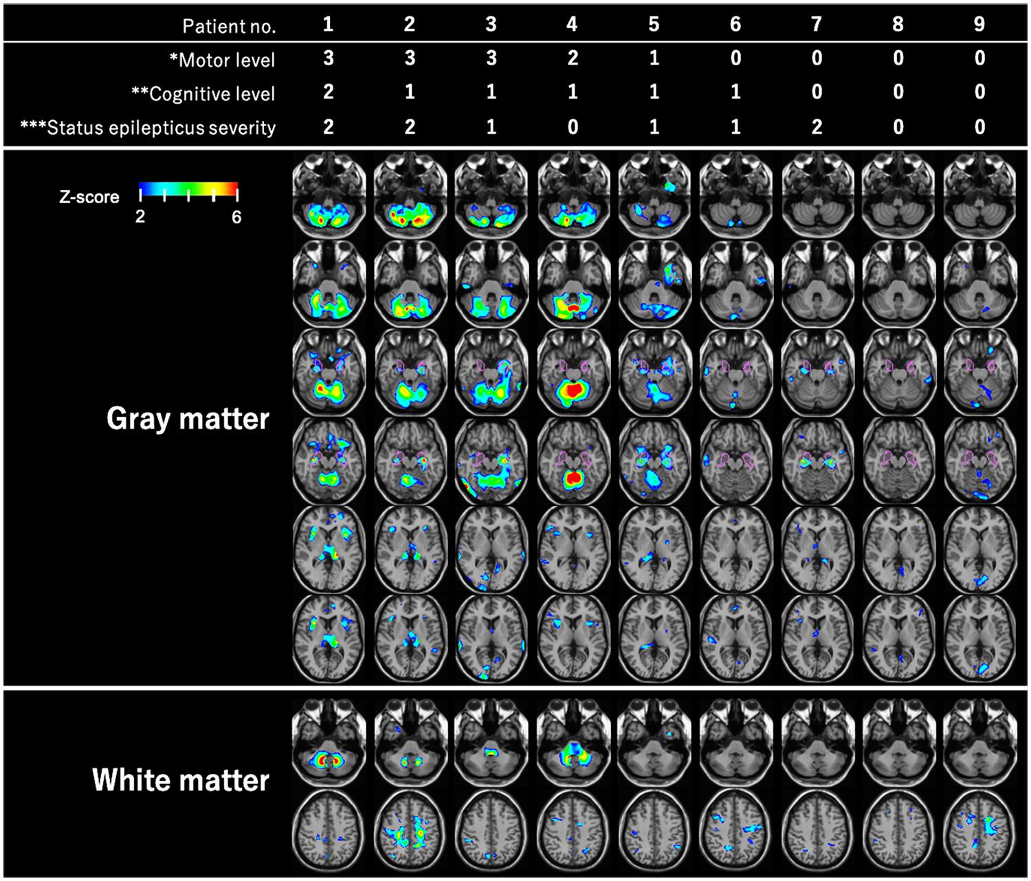 Brain structural changes in alternating hemiplegia of childhood using single-case voxel-based morphometry analysis