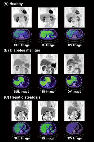 Impact of patient characteristic factors on the dynamics of liver glucose metabolism: Evaluation of multiparametric imaging with dynamic whole-body 18F-fluorodeoxyglucose-positron emission tomography